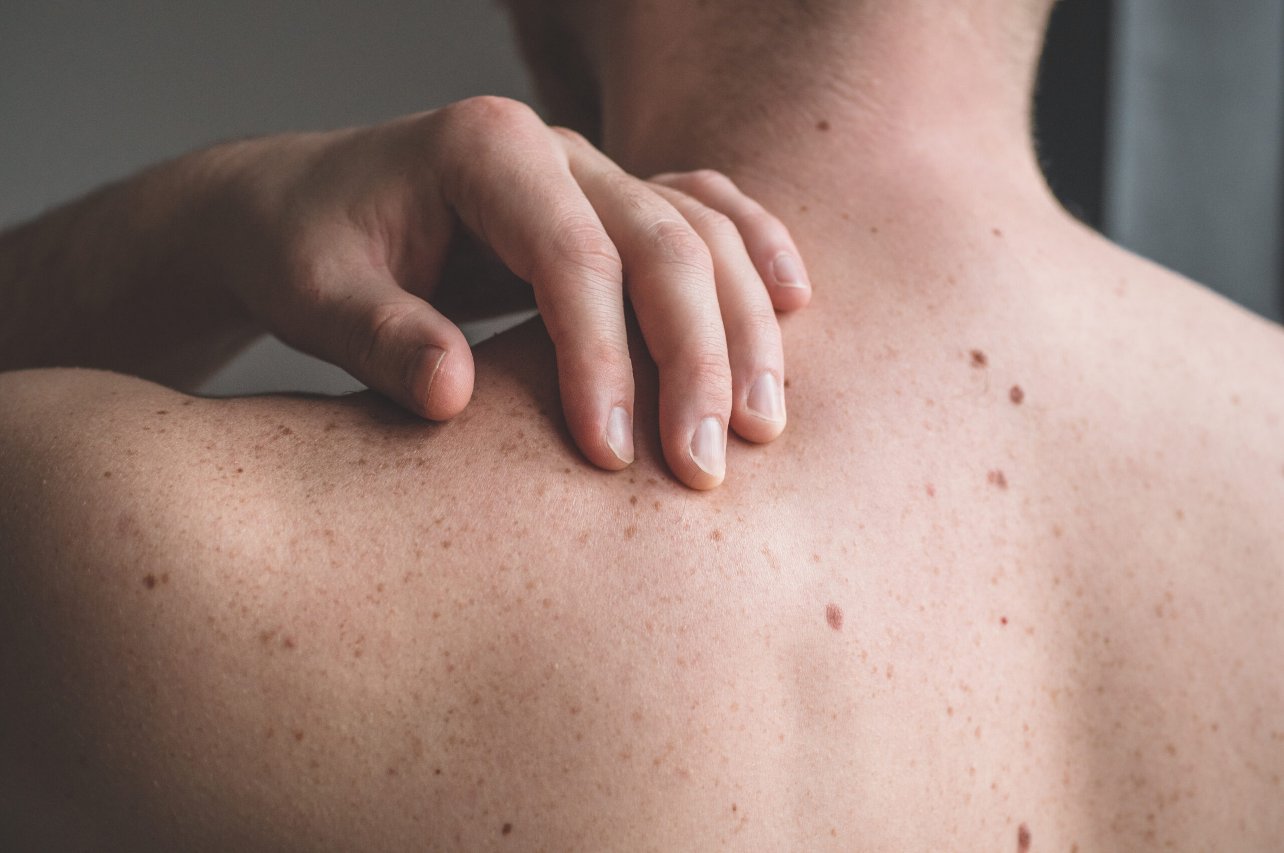 skin cancer screening Nashville dermatologist exam